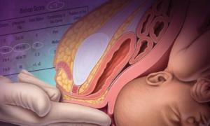 Амниотомия при родах: показания и последствия